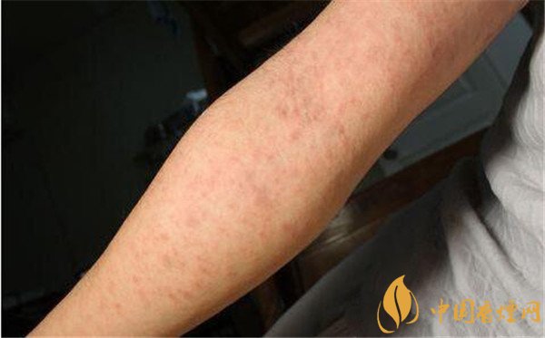 戒煙藥暢沛副作用有哪些 戒煙藥暢沛對人體的危害(有自殺風(fēng)險(xiǎn))